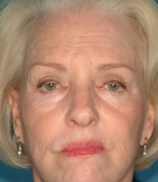 before laser skin resurfacing female patient front view case 4881 Crispin Plastic Surgery Atlanta, GA