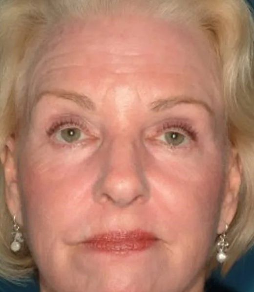 after laser skin resurfacing female patient front view case 4881 Crispin Plastic Surgery Atlanta, GA