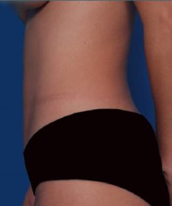 After Liposuction Female Patient Side Angle View Case 1535