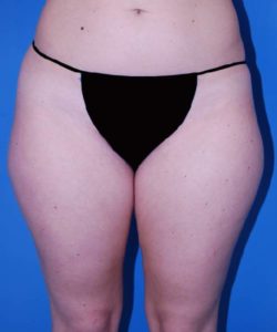 Before Liposuction Female Patient Lower Body View Case 1546