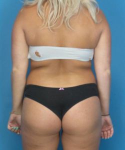 Before Liposuction Female Patient Back Angle View Case 1560