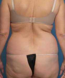 Before Liposuction Female Patient Back Angle View Case 1574