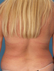 before liposuction female patient back view case 1877