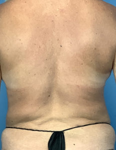 after liposuction female patient back view case 1877