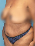 before liposuction female patient left angle view case 1880
