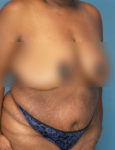 before liposuction female patient right angle view case 1880