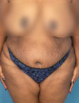 before liposuction female patient front view case 1880