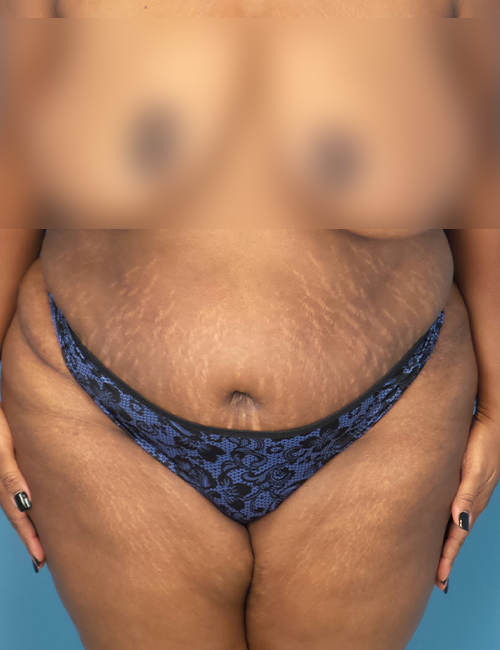 before liposuction female patient front view case 1880