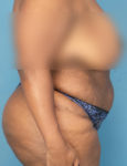 before liposuction female patient right side view case 1880
