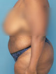 before liposuction female patient left side view case 1880