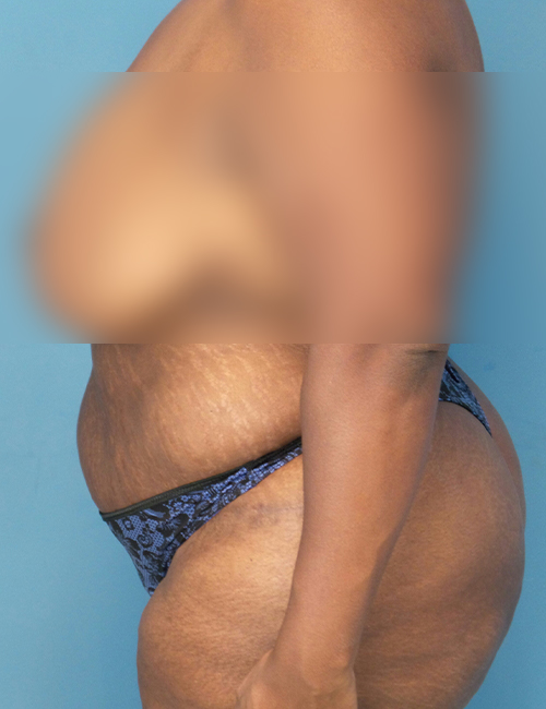 before liposuction female patient left side view case 1880