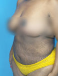 after liposuction female patient left angle view case 1880 | Crispin Plastic Surgery