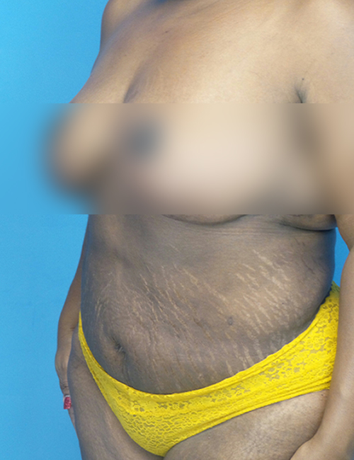 after liposuction female patient left angle view case 1880 | Crispin Plastic Surgery