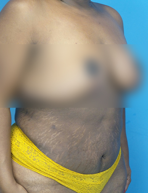 after liposuction female patient right angle view case 1880 | Crispin Plastic Surgery