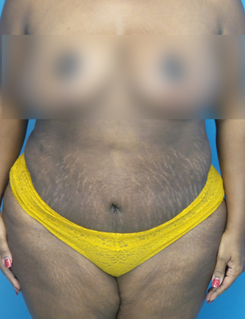 after liposuction female patient front view case 1880 | Crispin Plastic Surgery