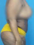 after liposuction female patient right side view case 1880 | Crispin Plastic Surgery