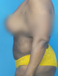 after liposuction female patient left side view case 1880 | Crispin Plastic Surgery