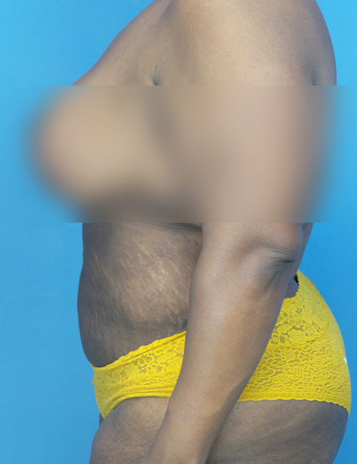 after liposuction female patient left side view case 1880 | Crispin Plastic Surgery