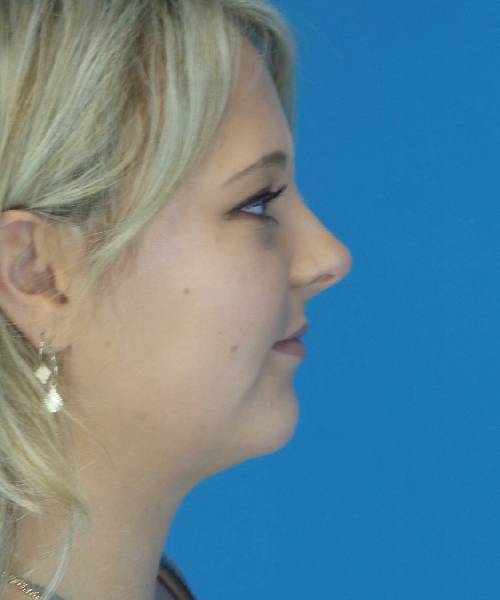 After Liposuction Female Patient Right Side Angle View Case 1549