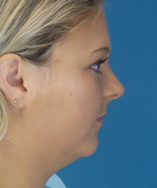 Before Liposuction Female Patient Right Side Angle View Case 1549