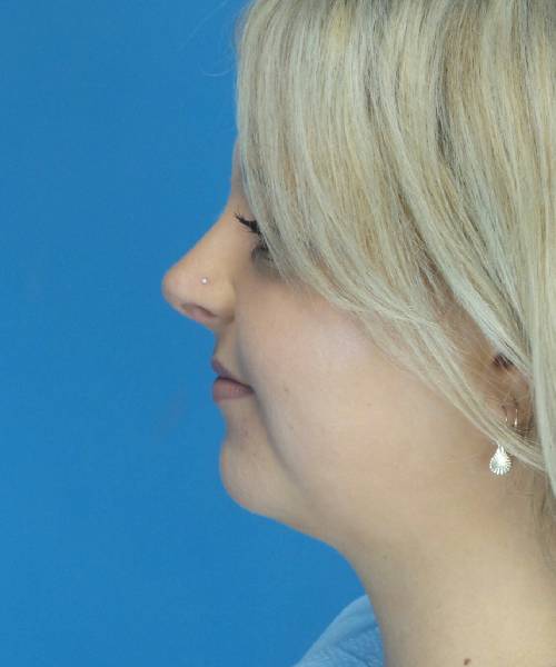After Liposuction Female Patient Left Side Angle View Case 1549