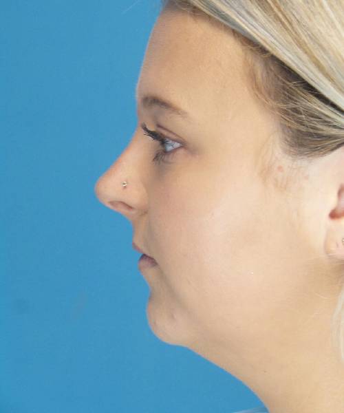 Before Liposuction Female Patient Left Side Angle View Case 1549