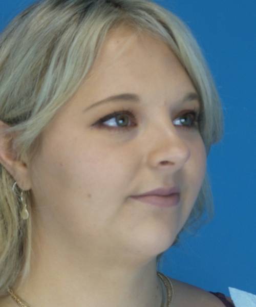 After Liposuction Female Patient Right Angled View Case 1549