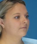 Before Liposuction Female Patient Right Angled View Case 1549