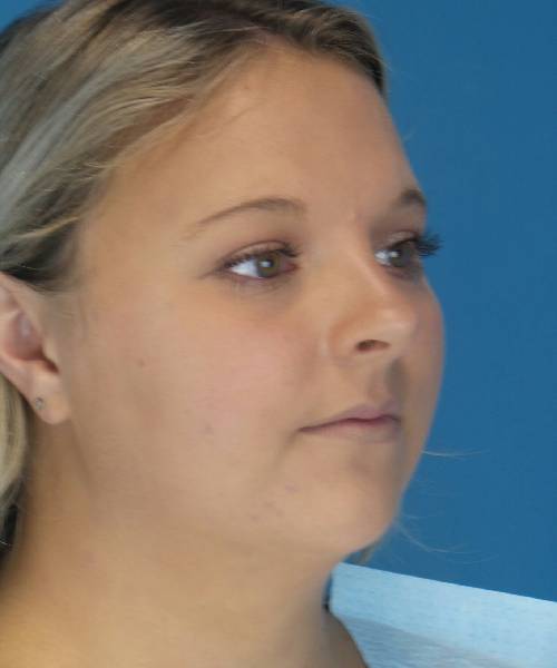 Before Liposuction Female Patient Right Angled View Case 1549