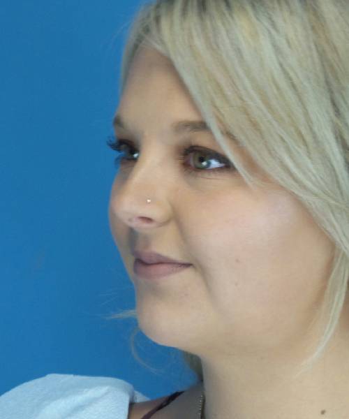 After Liposuction Female Patient Left Angled View Case 1549