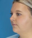 Before Liposuction Female Patient Left Angled View Case 1549