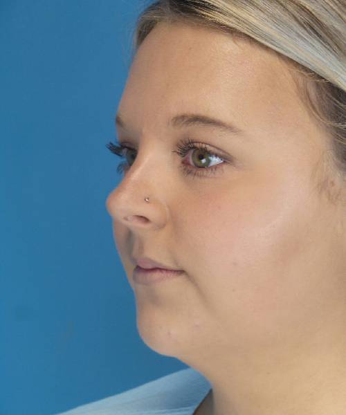 Before Liposuction Female Patient Left Angled View Case 1549