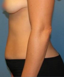 Before Liposuction Female Patient Side Angle View Case 1535