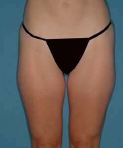 After Liposuction Female Patient Lower Body View Case 1546