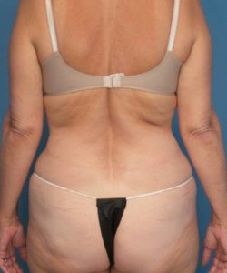 After Liposuction Female Patient Back Angle View Case 1574