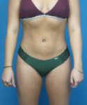 After Liposuction Female Patient Front Angle View Case 1563