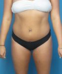 Before Liposuction Female Patient Front Angle View Case 1563