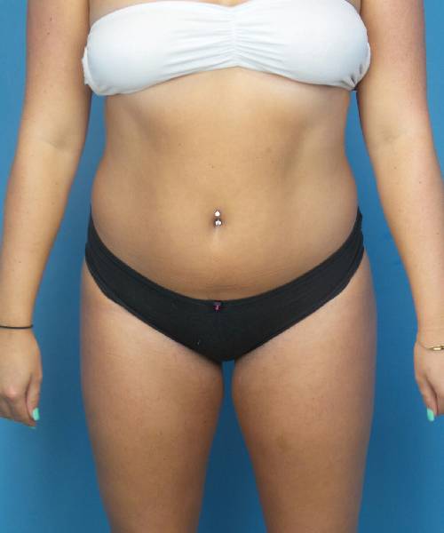Before Liposuction Female Patient Front Angle View Case 1563