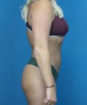 After Liposuction Female Patient Right Side Angle View Case 1563