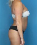 Before Liposuction Female Patient Right Side Angle View Case 1563