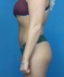 After Liposuction Female Patient Left Side Angled View Case 1563