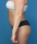 Before Liposuction Female Patient Left Side Angle View Case 1563