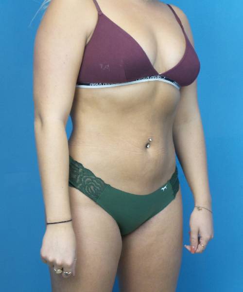 After Liposuction Female Patient Right Angled View Case 1563