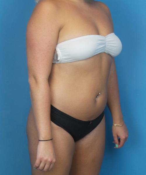 Before Liposuction Female Patient Right Angled View Case 1563