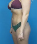 After Liposuction Female Patient Left Angled View Case 1563