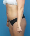 Before Liposuction Female Patient Left Angled View Case 1563