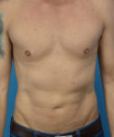 after liposuction male patient front view case 2590