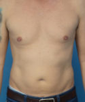 before liposuction male patient front view case 2590