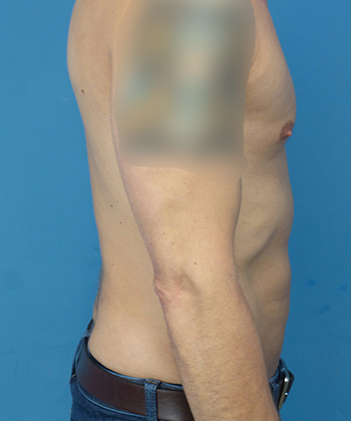 after liposuction male patient right side view case 2590