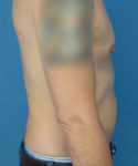 before liposuction male patient right side view case 2590